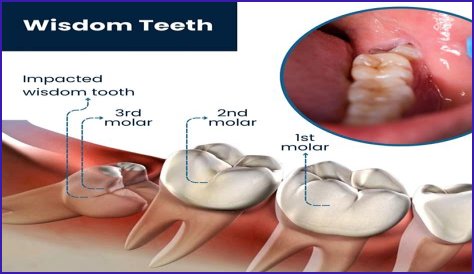 Parents of teen who died after getting wisdom teeth pulled accept $2M settlement